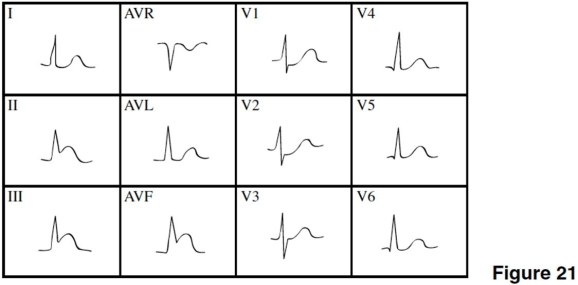 <strong> In Figure 21,there is evidence of</strong> A)anterior wall ischemia. B)anterior MI. C)NSTEMI. D)inferior/posterior MI.