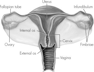 Please circle the parts of this figure that are affected by pelvic inflammatory disease.Then discuss the long-term consequences of pelvic inflammatory disease.