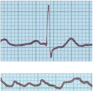 <strong>In the figure shown here, the top ECG shown is normal. What condition does the bottom ECG indicate? </strong> A) ventricular fibrillation B) a heart murmur C) hypertension D) stroke E) angina pectoris