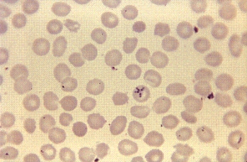 <strong>A 15-year-old boy spent most of the summer at the northern Minnesota family cabin on a lake in a densely wooded area. After returning to school in the fall, he was frequently tired and listless with periods of fever and chills. A blood sample revealed the following organism at 1000 \times . The most likely identification is </strong> A) Plasmodium ovale. B) Babesia microti. C) Plasmodium malariae. D) Trypanosoma cruzi.