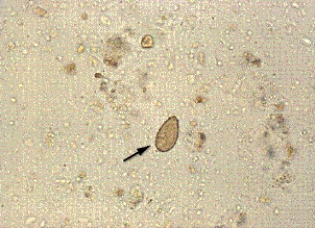 <strong>A woman who just returned from a trip to Southeast Asia has signs of biliary obstruction, which is confirmed by CT scan. Due to her recent travel history, the physician orders an ova and parasites examination before considering surgical intervention. The following element is found in her fecal sample at 400 \times . The most likely identity of this organism is </strong> A) Schistosoma mansoni. B) Clonorchis sinensis. C) Fasciola hepatica. D) Heterophyes heterophyes.