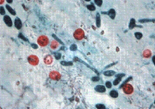 <strong>Five members of a family develop a sudden onset of watery diarrhea, nausea, vomiting, headache, and cramps. The family physician orders fecal cultures and complete ova and parasites analysis. Each sample reveals the presence of organisms seen below at 1000 \times . The most likely cause of the infection is </strong> A) Cryptosporidium parvum. B) Isospora belli. C) Cyclospora cayetanensis. D) Encephalitozoon intestinalis.