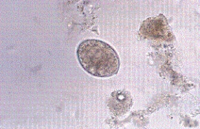 <strong>A housewife from the Great Lakes area presents to her family physician with fatigue and malaise. Blood tests show that she has enlarged but pale RBCs (megaloblastic anemia) along with a vitamin B<sub>12</sub> deficiency. Her history includes a dietary habit of making pickled fish, a family favorite. Because of this, an ova and parasites examination is also requested and reveals the following at 400 \times . What is the identity of this parasite? </strong> A) Hymenolepis nana B) Taenia saginata C) Diphyllobothrium latum D) Taenia solium