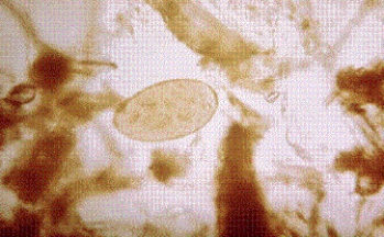 <strong>A farmer who raises sheep and cattle shows signs of jaundice. Along with elevated liver enzymes, he also has an elevated eosinophil count. A fecal sample for ova and parasites shows the parasite form seen below at 400 \times . The organism causing this infection is </strong> A) Paragonimus westermani B) Heterophyes heterophyes C) Schistosoma mansoni D) Fasciola hepatica