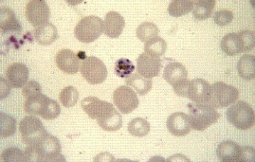 <strong>A woman patient with history of travel to tropical Africa was noncompliant with her antimalarial medications. She now has a cyclical fever and paroxysm every 72 hours. The following organism is seen in her peripheral blood smear at 1000 \times is consistent with an infection caused by </strong> A) Plasmodium ovale. B) P. vivax. C) P. falciparum. D) P. malariae.