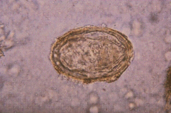 <strong>A patient with recent history of travel to the Philippines has bloody diarrhea. An ova and parasites examination of the stool shows the following at 400 \times . </strong> A) Schistosoma mansoni B) S. japonicum C) S. haematobium D) S. madurella