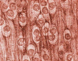 <strong>A patient with a history of eating wild game comes to the physician with a history of diarrhea over the past 3 weeks. In addition, he complains of fever, muscular pain and tenderness, headache, and general weakness. The patient also has a significant eosinophilia. A biopsy of a nodular area on his forearm is seen in the image below. This is consistent with a diagnosis of infection caused by </strong> A) Leishmania donovani. B) Wuchereria bancrofti. C) Trichinella spiralis. D) Loa loa.