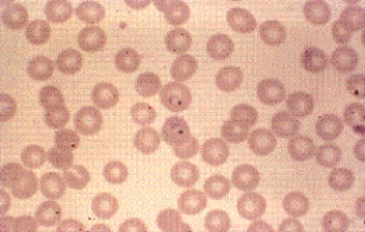 <strong>A patient comes to the emergency department stating that he has fever and chills every 48 hours. The patient has a history of travel to Central America in the past month and did not take any preventative measures against malaria. A complete blood count shows the following RBC inclusions at 1000 \times . This organism is most likely </strong> A) Plasmodium malariae. B) P. ovale. C) P. falciparum. D) P. vivax.