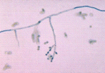 <strong>A graduate student returning from a month-long fieldwork experience in South America develops a dark nodular lesion on his left hand. Microscopic examination of the nodule reveals dark, coinlike inclusions. The following organism grows in culture. This organism is most likely  </strong> A) Cladosporium spp. B) Candida spp. C) Coccidioides immitis. D) Cryptococcus neoformans. <div style=padding-top: 35px> 