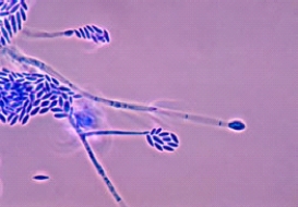 <strong>A patient who wears long-term contact lenses comes to her physician after noting a small spot on her cornea. Collection of the lesion for culture produced a fast-growing mold with a slight pink color on the surface. Microscopic review showed the following organism. This organism is most likely  </strong> A) Sporothrix schenckii. B) Fusarium spp. C) Mucor spp. D) Geotrichum spp. <div style=padding-top: 35px> 