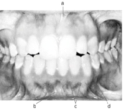 <strong>In the following illustration,structure c is the </strong> A) mucogingival junction B) mandibular labial frenum C) maxillary labial frenum D) mucobuccal fold