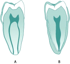 Which of the following best describes the root canal opening(s)in the figure A below?