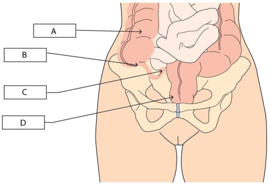 <strong> A nurse checking for tenderness at McBurney point for a client with suspected appendicitis will palpate which area?</strong> A)A B)B C)C D)D