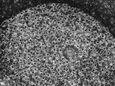 <strong>Which of the following is NOT involved in the development of acne?</strong> A)excessive production of sebum B)Staphylococcus epidermidis C)dead skin cells D)hair follicles E)neutrophils