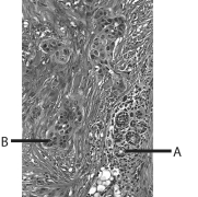 <strong>Which of the following statements concerning cancer cells is most accurate?</strong> A)Proto-oncogenes are part of the regulatory section of a chromosome. B)Tumor cells have lost their ability to stop dividing. C)Proto-oncogenes help control runaway cell division. D)Benign tumor cells usually spread only to adjacent organs. E)Metastasis is the spread of benign cells.
