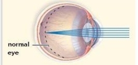 In the abnormal eyeball pictured here,the size of a normal eye is noted with a dotted line.This type of abnormality results in