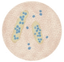 <strong>You are performing a microscopic examination of Mr. Henderson's urine sample. Under high-power magnification, you see the items shown in the picture. Which of the following is the most likely cause? </strong> A) Vigorous exercise B) Pyelonephritis C) Heavy-metal poisoning D) Renal ischemia E) Allergic reaction