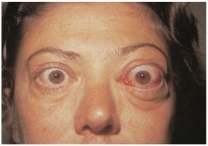 <strong>The nurse is caring for a client with Graves disease.When observing the facial features of the client (pictured below),the nurse notes that the client is exhibiting which associated sign of the disease? </strong> A)Conjunctivitis B)Lacrimation C)Periorbital edema D)Exophthalmos