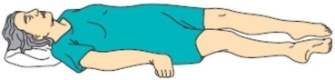 <strong>The nurse notices that a client who sustained a head injury from a motor vehicle crash begins to demonstrate an abnormal posture.(See image. )What does this posture suggest to the nurse about the client's brain functioning?  </strong> A)Improved level of consciousness B)Developing a seizure disorder C)Brainstem impairment D)Corticospinal tract impairment <div style=padding-top: 35px> 