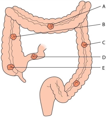 <strong>The nurse is caring for a client with colorectal cancer who is postoperative from a transverse colostomy placement.What area of the bowel is involved? </strong> A)A B)B C)C D)D E)E