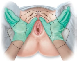 <strong>A pregnant patient is having pelvic measurements made. Which approach should the examiner use to determine this patient's estimated length of the pubic ramus?</strong> A) B) C) D)