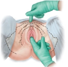 <strong>A pregnant patient is having pelvic measurements made. Which approach should the examiner use to determine this patient's estimated length of the pubic ramus?</strong> A) B) C) D)
