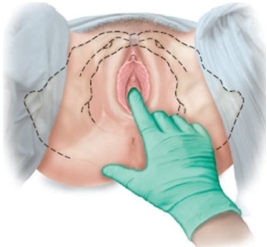 <strong>A pregnant patient is having pelvic measurements made. Which approach should the examiner use to determine this patient's estimated length of the pubic ramus?</strong> A) B) C) D)