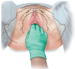 <strong>A pregnant patient is having pelvic measurements made. Which approach should the examiner use to determine this patient's estimated length of the pubic ramus?</strong> A) B) C) D)