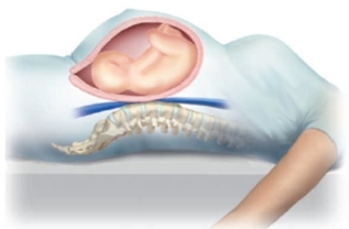 A pregnant patient is observed lying in bed in the following position. Which health problem is this patient prone to developing?
