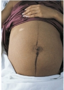 During a routine assessment of a pregnant patient the nurse observes the following on the patient's abdomen. How should the nurse document this finding?