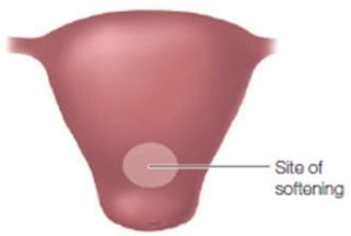 During a pelvic examination of a pregnant patient the following area is identified as being softened. How should the nurse document this finding?