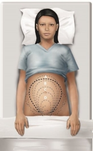 The nurse is evaluating the fundal height of a patient who is 20 weeks pregnant. Which height should the nurse expect to assess in this patient?