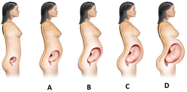 A patient at 28 weeks' gestation asks the nurse why she has backaches. To help explain the changes, the nurse shows her a picture of the shape of her back. Which picture should the nurse use?