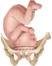 <strong>The fetus of a patient in labor is determined to be in the brow presentation. Which diagram should the nurse provide to the patient to explain this position?</strong> A) B) C) D)