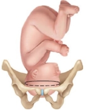 <strong>The fetus of a patient in labor is determined to be in the brow presentation. Which diagram should the nurse provide to the patient to explain this position?</strong> A) B) C) D)