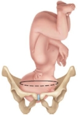 <strong>The fetus of a patient in labor is determined to be in the brow presentation. Which diagram should the nurse provide to the patient to explain this position?</strong> A) B) C) D)