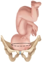<strong>The fetus of a patient in labor is determined to be in the brow presentation. Which diagram should the nurse provide to the patient to explain this position?</strong> A) B) C) D)