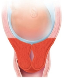 <strong>The cervix of a laboring patient is measured as being 50% effaced. Which diagram should the nurse use to explain this finding to the patient?</strong> A) B) C) D)