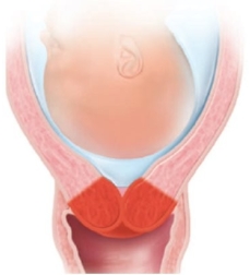<strong>The cervix of a laboring patient is measured as being 50% effaced. Which diagram should the nurse use to explain this finding to the patient?</strong> A) B) C) D)