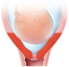 <strong>The cervix of a laboring patient is measured as being 50% effaced. Which diagram should the nurse use to explain this finding to the patient?</strong> A) B) C) D)