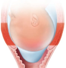 <strong>The cervix of a laboring patient is measured as being 50% effaced. Which diagram should the nurse use to explain this finding to the patient?</strong> A) B) C) D)
