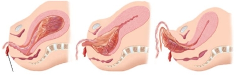 <strong>The nurse is assisting in the delivery of a pregnant patient's placenta post-delivery. The placenta appears as follows. What term should the nurse use to document this placental delivery? </strong> A) Schultz mechanism of delivery B) Duncan mechanism of delivery C) Complete mechanism of delivery D) Incomplete mechanism of delivery