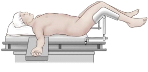 A patient is undergoing a surgical procedure. Based on the figure, which intraoperative position does this represent? 1)Fowler's 2)Low lithotomy 3)Supine 4)Trendelenburg