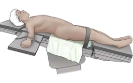 A patient is undergoing a surgical procedure. Based on the figure, which intraoperative position does this represent? 1)Fowler's 2)Jackknife 3)Reverse Trendelenburg 4)Trendelenburg