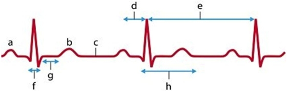   -Identify the ECG component labeled h.