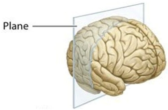 <strong> In this figure, the plane of section divides the brain into ________ parts.</strong> A)anterior and posterior B)superior and inferior C)medial and lateral D)proximal and distal