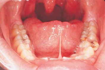 <strong> This patient exhibits an extensive adhesion of the tongue to the floor of the mouth caused by the short lingual frenum. You suspect:</strong> A) ankyloglossia. B) frenectomy. C) lingual thyroid. D) total ankyloglossia.