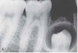 <strong> This unilocular radiolucency around the crown of an unerupted second premolar is most likely a:</strong> A) normal developmental sac. B) dentigerous cyst. C) primordial cyst. D) lateral periodontal cyst.