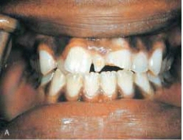 <strong> The supernumerary tooth in this illustration is called:</strong> A) mesiodens. B) dilaceration. C) twinning. D) gemination.