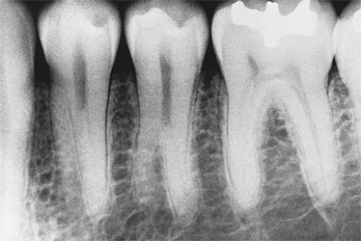 <strong> The developmental anomaly seen in this radiograph is:</strong> A) taurodontism. B) mulberry molar. C) supernumerary roots on the premolars. D) dilaceration.